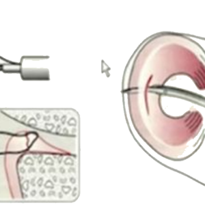 AccurFix meniscal repair procedure